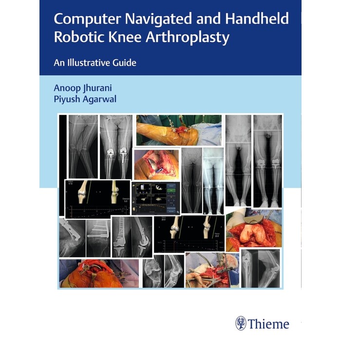 Piyush Agarwal: Computer Navigated and Handheld Robotic Knee Arthroplasty - gebunden